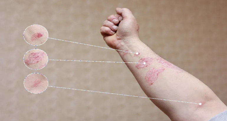 Sedef Tanı ve Tedavisi