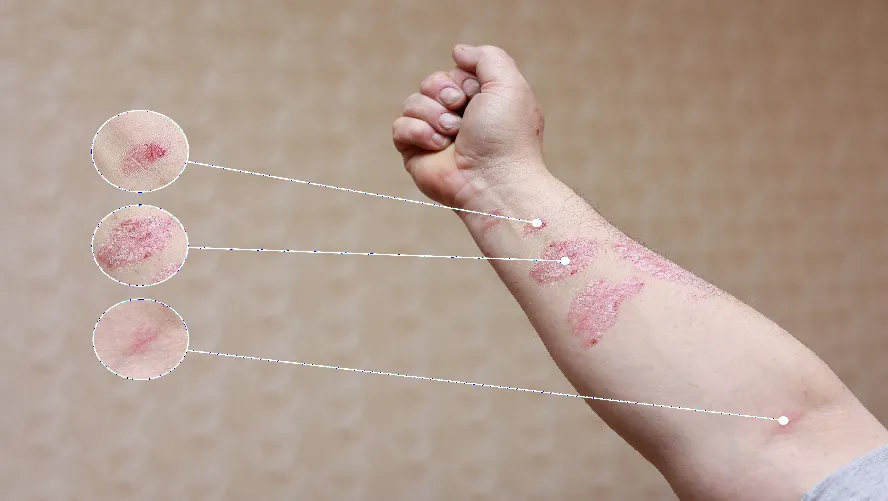 Sedef Tanı ve Tedavisi